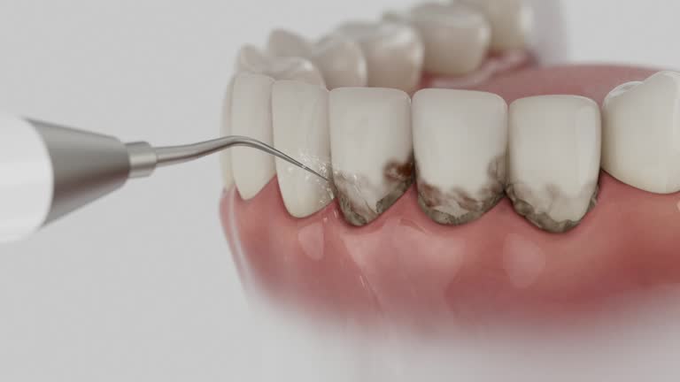 Reliable Tooth Extraction contractor in Princeton, MO by Smile Center Dentistry